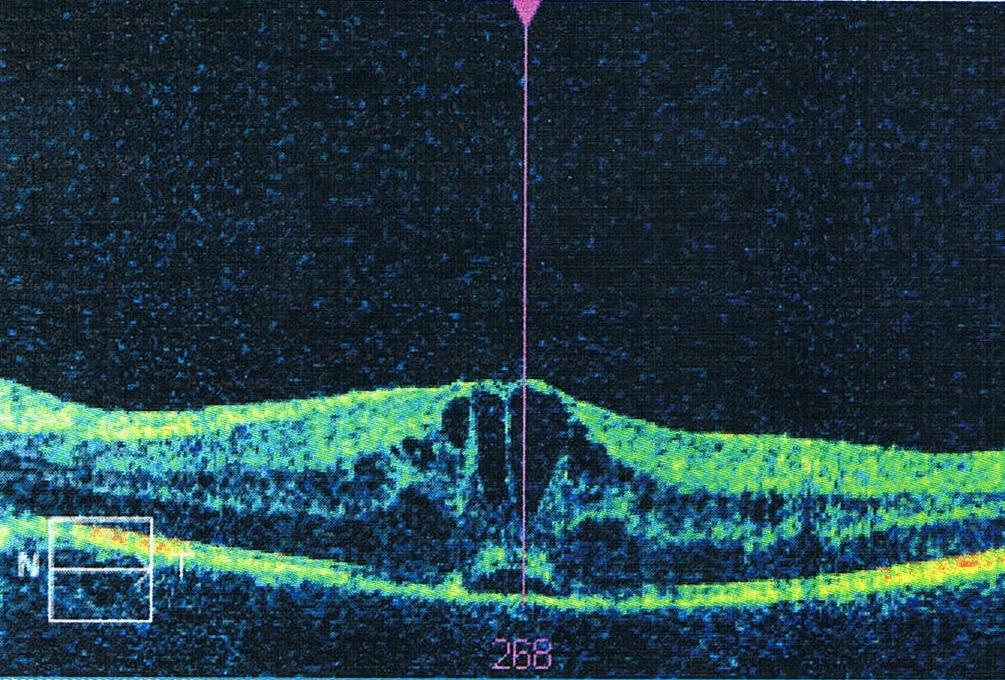 AMD – Altersbedingte Makula-Degeneration
