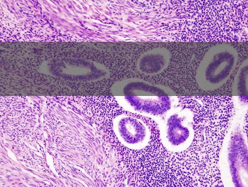 Wann muss der Uterus raus ?